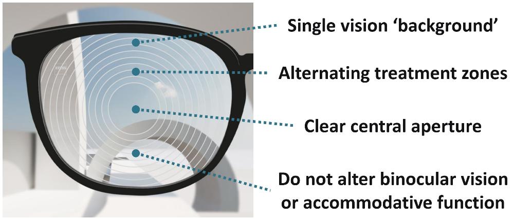 Myopia control lens diagram — treatment zones for slowing nearsightedness in children