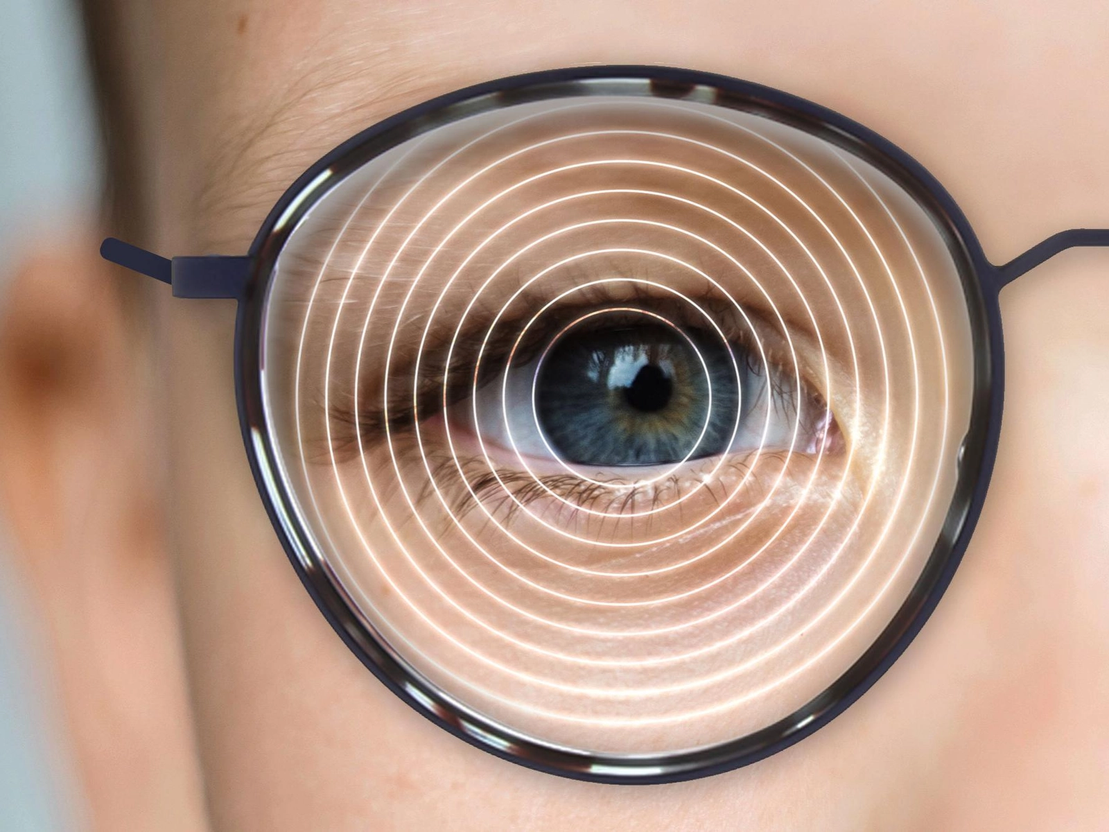 Myopia control lens — concentric ring design to slow nearsightedness